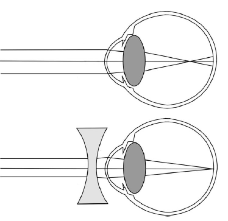 myopia, myopia correction