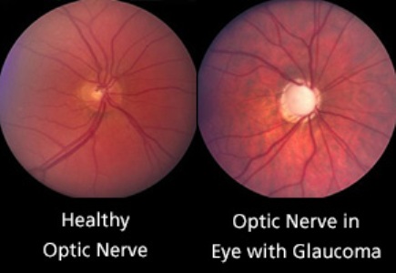 Glaucoma - The Silent Thief of Sight