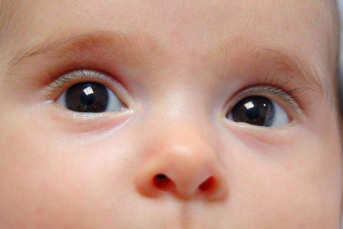 Cataracts  Can They Affect Children?